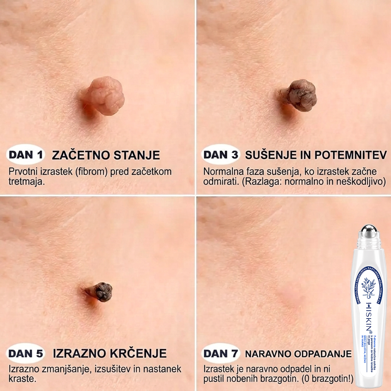 HISKIN® 🎁🎁🎁 Na voljo je le še 10 paketov! Zagotovite si dodatnih 50 % popusta! Ne zamudite te ponudbe, saj bo naslednja priložnost šele prihodnje leto.
